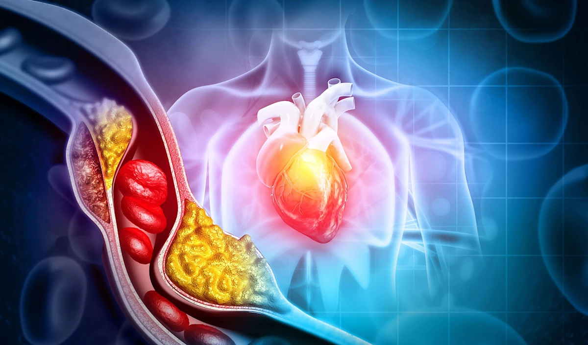 زيادة الكوليسترول يسبب أكثر من 2.6 مليون حالة وفاة سنوياً