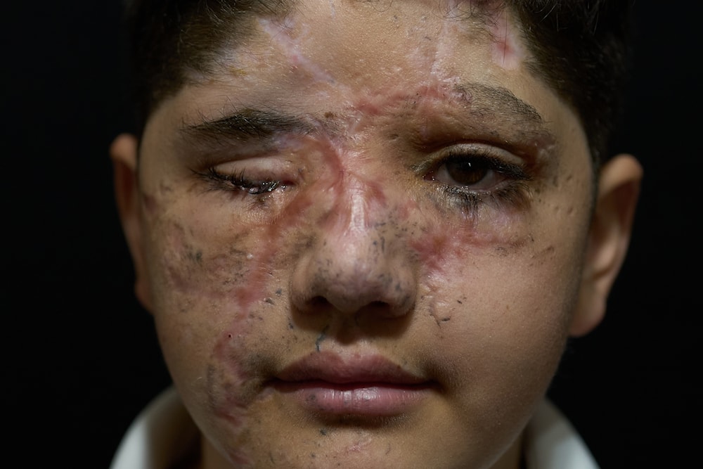  أحد الجرحى بمجزرة البيجر(أسوشييتد برس)