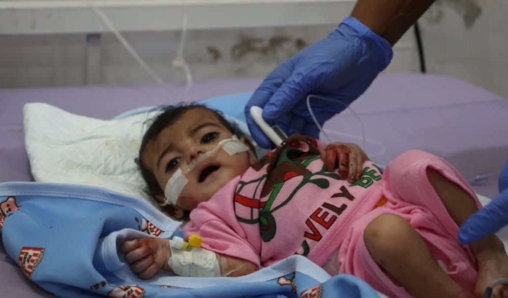 «أطباء بلا حدود»: أطفال اليمن يصلون إلى المستشفيات بحالات سوء تغذية حرجة